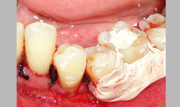 Root canal treatment in Anand
                        